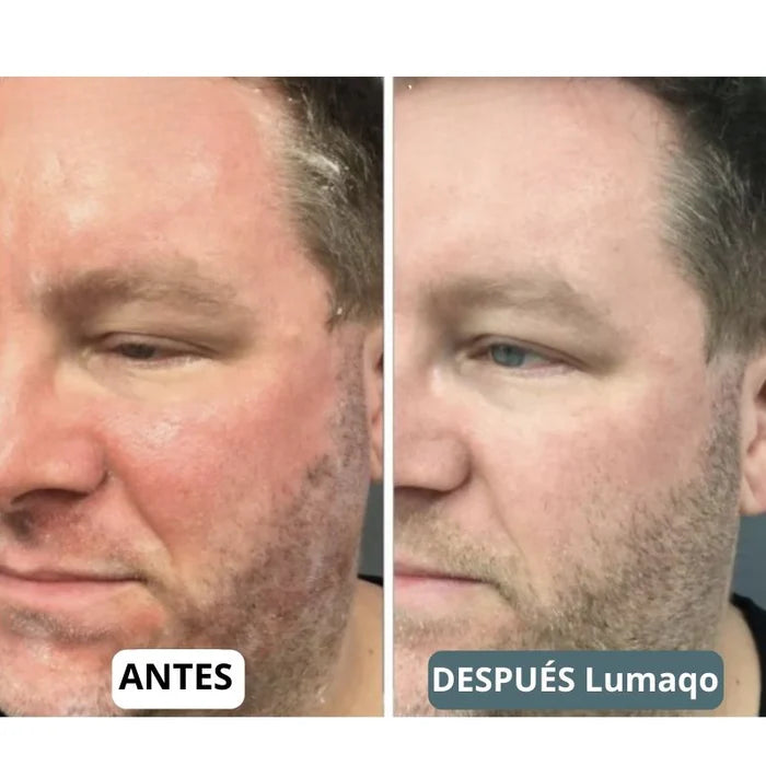 DermaCare - Recupere a sua barba e couro cabeludo em 14 dias